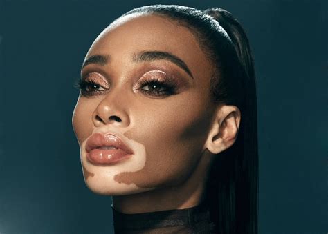 vitiligo nude|Winnie Harlow Poses Nude to Show Beauty of Her Vitiligo